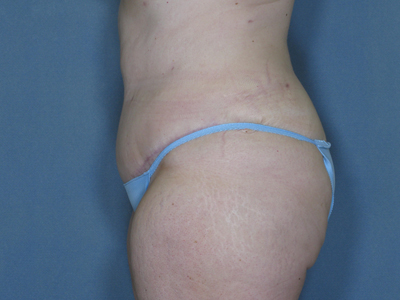 Tummy Tuck Before & After Patient #1657