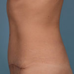 Tummy Tuck Before & After Patient #1745