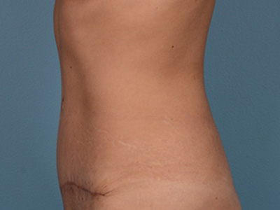 Tummy Tuck Before & After Patient #1745