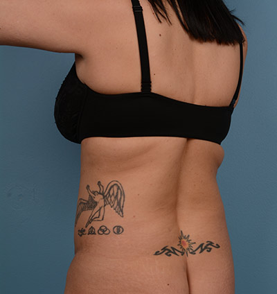 Liposuction Before & After Patient #671