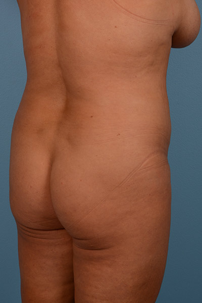 Brazilian Butt Lift (BBL) Before & After Patient #543