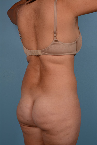 Brazilian Butt Lift Before & After Patient #555