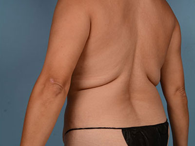 Tummy Tuck Before & After Patient #2049