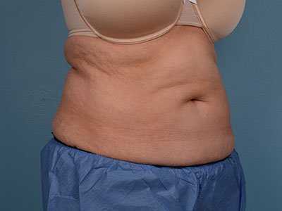 CoolSculpting Before & After Patient #1402