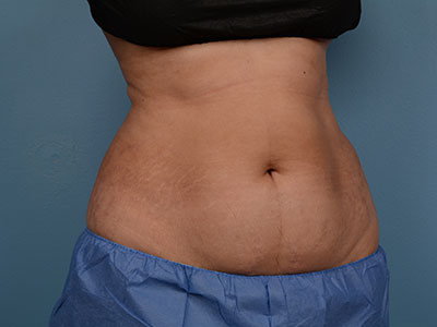 CoolSculpting Before & After Patient #1450