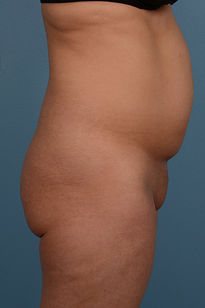 Brazilian Butt Lift (BBL) Before & After Patient #568