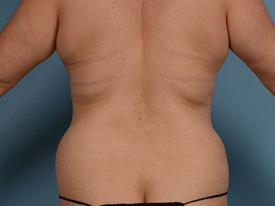 Tummy Tuck Before & After Patient #2111