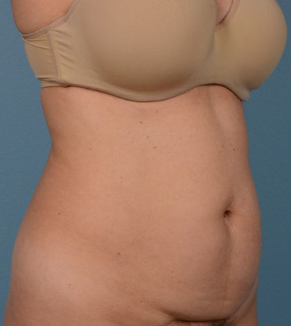 Vaser Liposuction Before & After Patient #2300