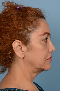 Face & Neck Lift Before & After Patient #4185