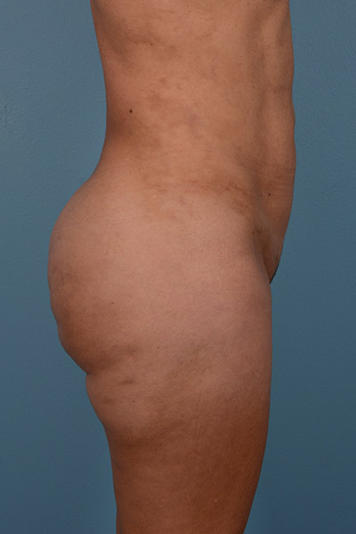Brazilian Butt Lift (BBL) Before & After Patient #555
