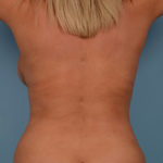 Liposuction Before & After Patient #710