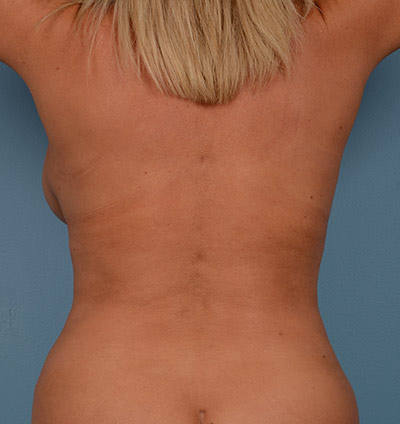 Liposuction Before & After Patient #710