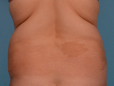 Tummy Tuck Before & After Patient #1321
