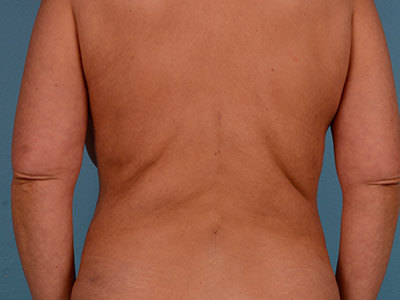 Tummy Tuck Before & After Patient #1366