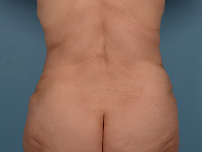 Tummy Tuck Before & After Patient #1728