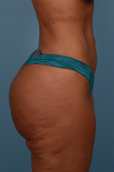 Brazilian Butt Lift Before & After Patient #606