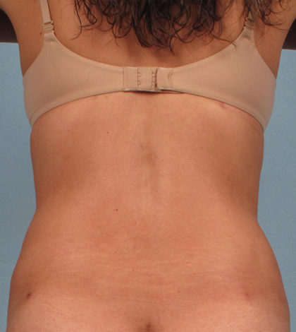 Vaser Liposuction Before & After Patient #2181