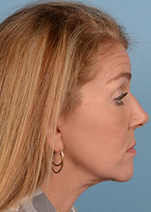 Face & Neck Lift Before & After Patient #4173