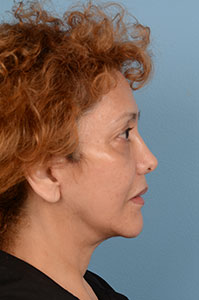 Face & Neck Lift Before & After Patient #4185