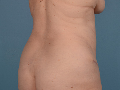 Tummy Tuck Before & After Patient #1707