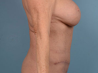 Tummy Tuck Before & After Patient #2024