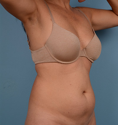 Liposuction Before & After Patient #690