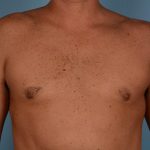 Gynecomastia Before & After Patient #2341