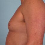 Gynecomastia Before & After Patient #2341