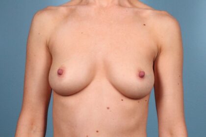 Breast Augmentation Before & After Patient #4409
