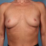 Breast Augmentation Before & After Patient #4416