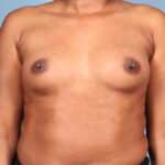 Breast Augmentation Before & After Patient #4402