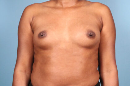 Breast Augmentation Before & After Patient #4402