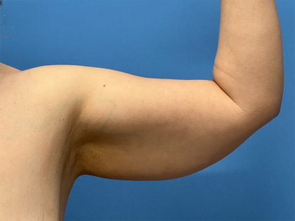 Arm Lift Before & After Patient #5331