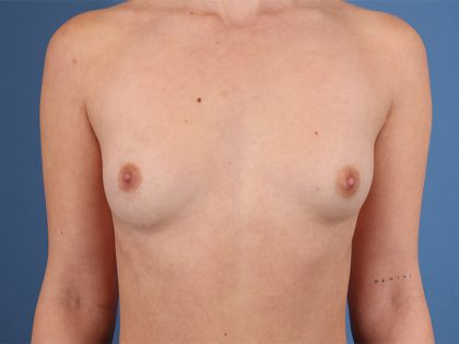 Breast Augmentation Before & After Patient #6416