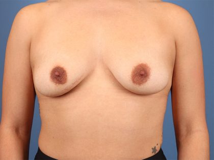 Breast Augmentation Before & After Patient #6419