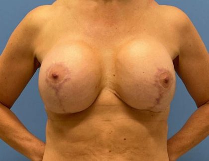 Breast Lift with Augmentation Before & After Patient #6512