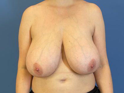 Breast Reduction Before & After Patient #6579