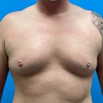 Gynecomastia Before & After Patient #6644
