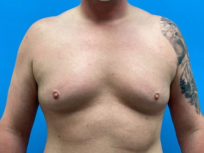 Gynecomastia Before & After Patient #6644