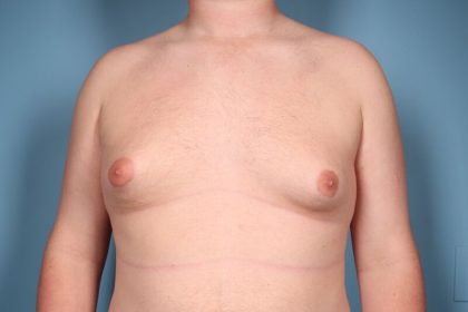Gynecomastia Before & After Patient #6646