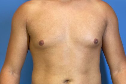 Gynecomastia Before & After Patient #6648