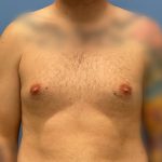 Gynecomastia Before & After Patient #6650