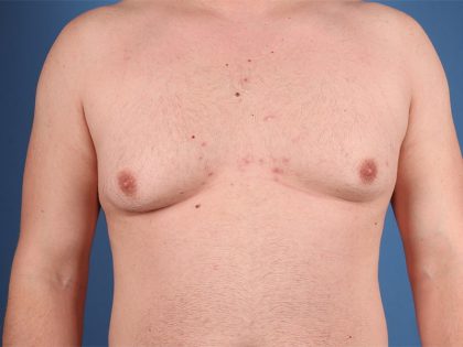 Gynecomastia Before & After Patient #6653