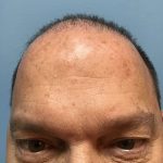 Hair Transplant Before & After Patient #6909