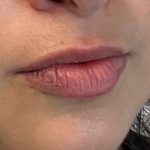 Lip Fillers Before & After Patient #7190