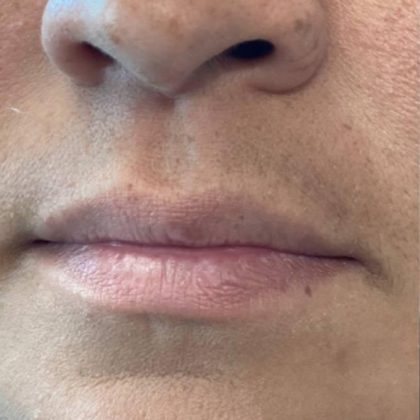 Lip Fillers Before & After Patient #7191