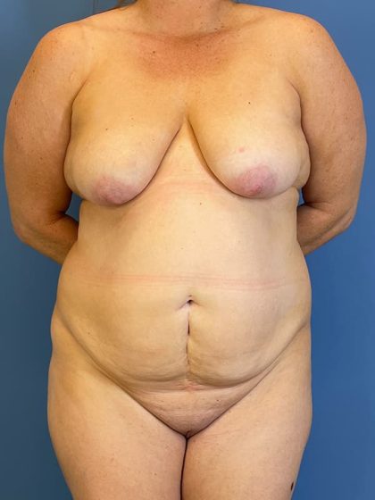 Lipoabdominoplasty Before & After Patient #5600