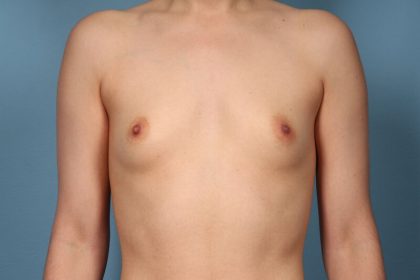 Breast Augmentation Before & After Patient #6174