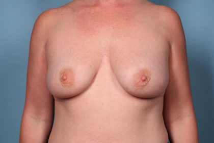 Breast Augmentation Before & After Patient #6181
