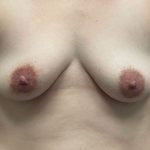 Breast Augmentation Before & After Patient #6182